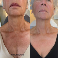 NECK LIFT CREAM. Інтенсивний анти-ейдж крем для шкіри шиї та декольте з 6-ма видами розчинного мікроколагену (колагенові нитки) і 22-ма активними інгредієнтами для клітинного омолодження, 50 гр