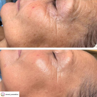V TOX LIFT MASK. Ультраактивная маска для безинъекционного нитевого лифтинга с 11-ю Пептидами и 6-ю видами Коллагена. Инновационная жидкая формула с трансформацией на коже: высыхание, глянцевый каркас, сильное лифтинговое натяжение, 100 мл